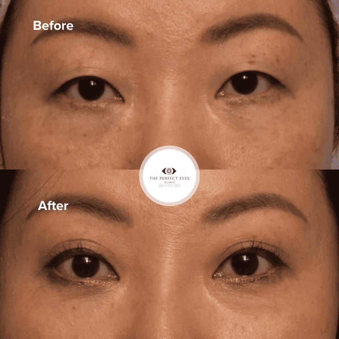 Double Eyelid Surgery before and after, a patient of Dr Sabrina Shah-Desai
