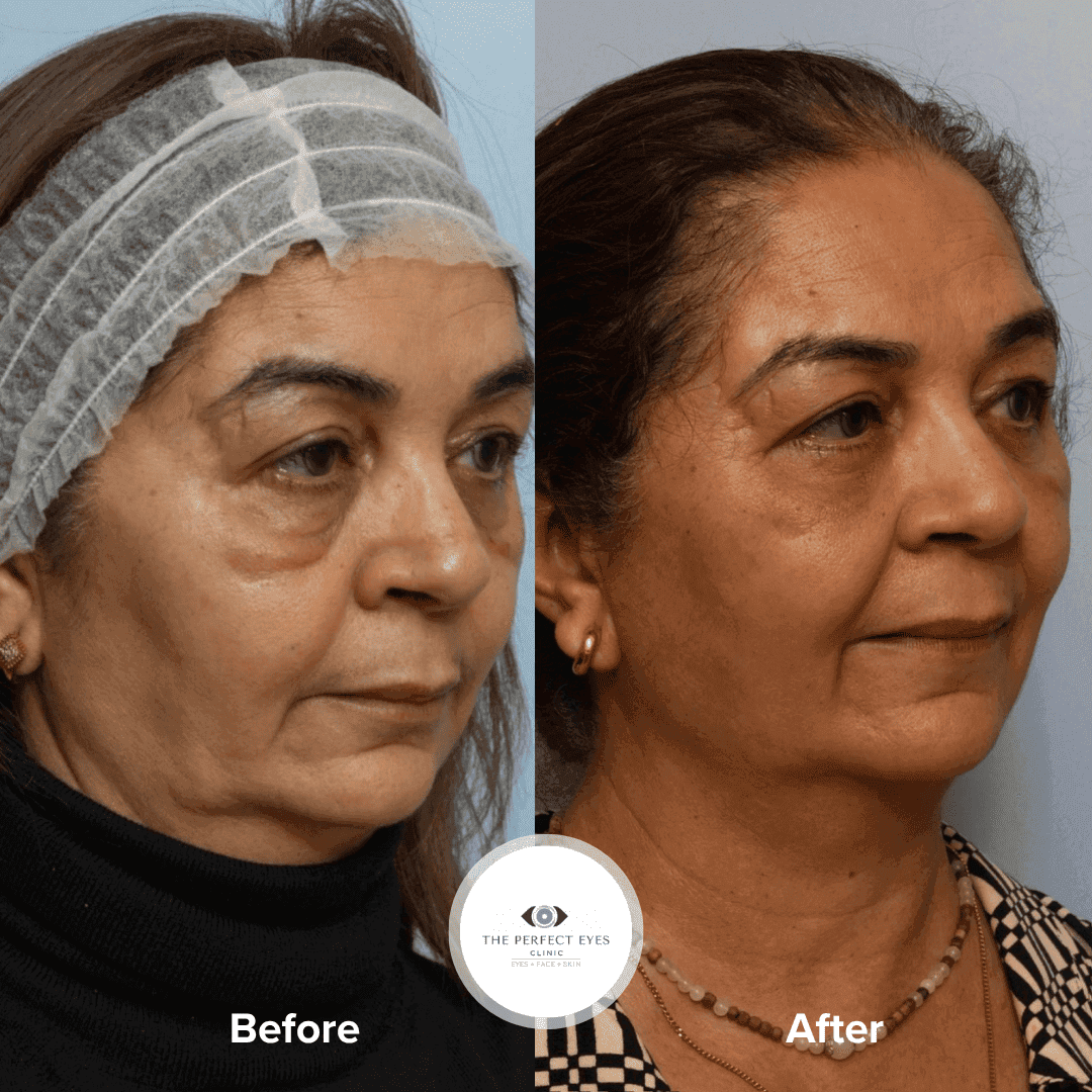 Extended Lower Eyelid Blepharoplasty before and after, a patient of Dr Sabrina Shah-Desai