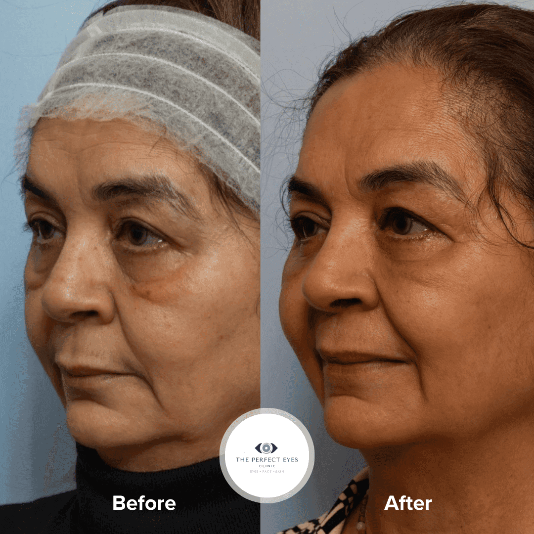 Lower Blepharoplasty before and after, a patient of Dr Sabrina Shah-Desai