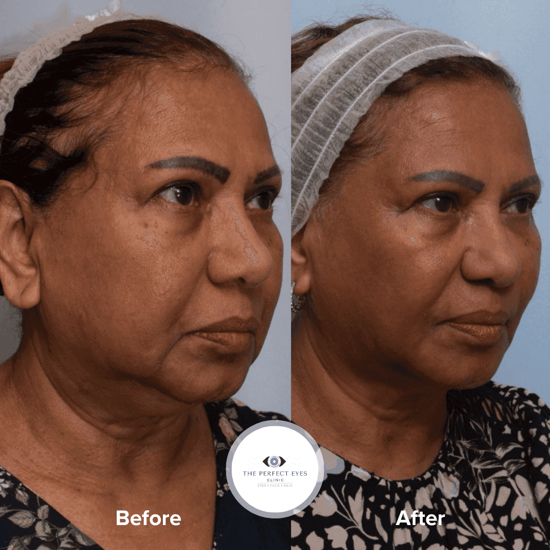 Endolift® before and after, a patient of Dr Sabrina Shah-Desai