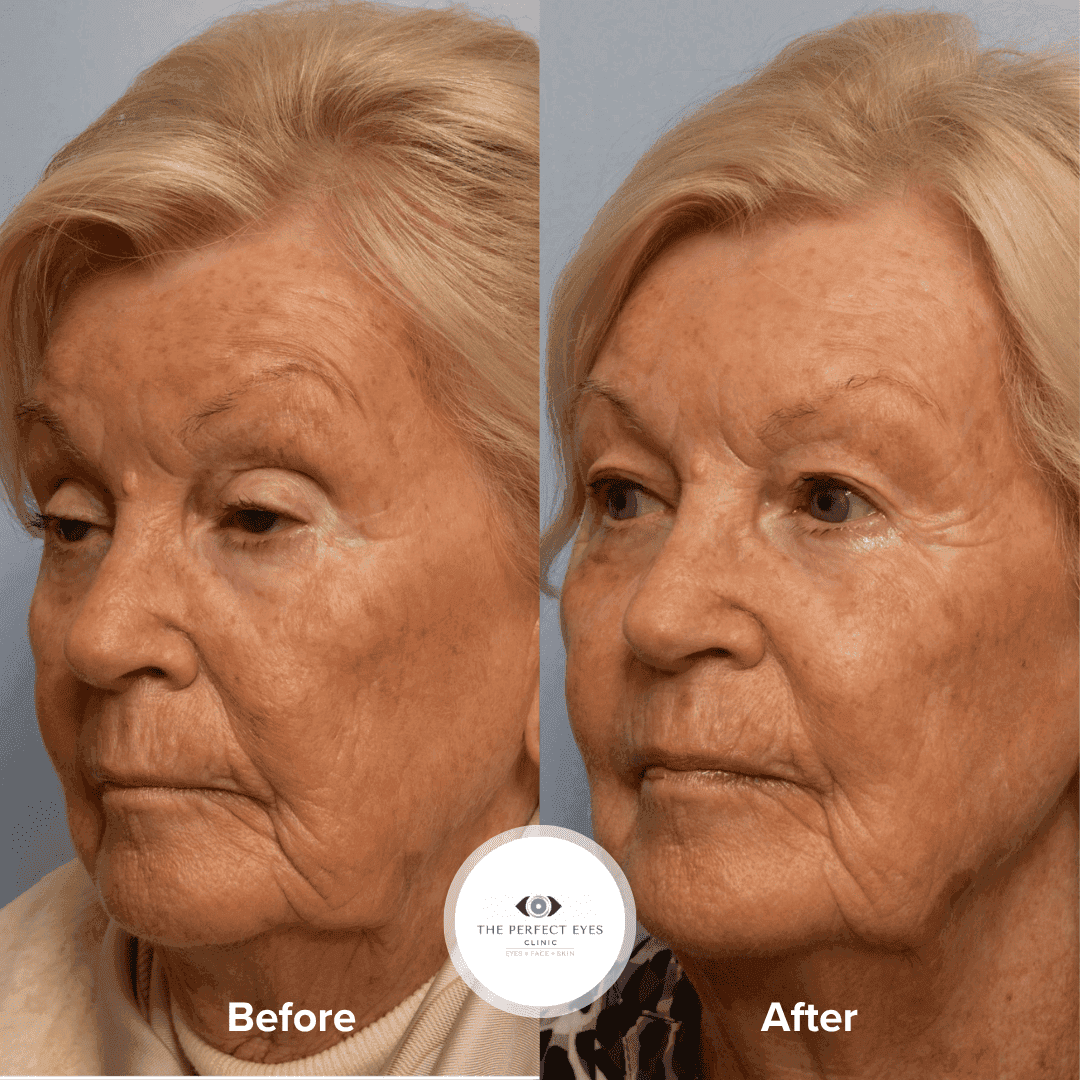 Ptosis Surgery before and after, a patient of Dr Sabrina Shah-Desai