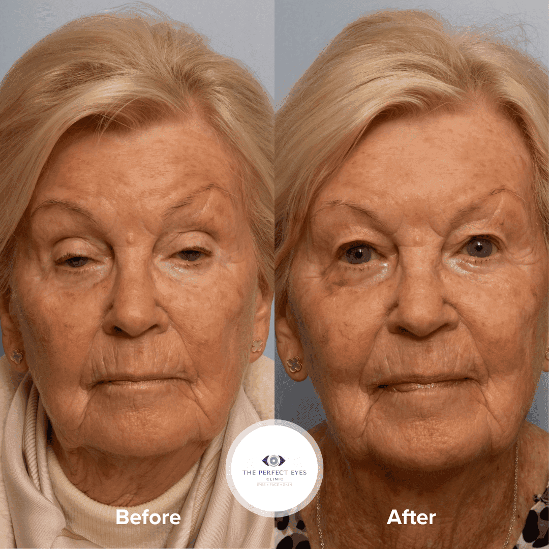 Ptosis Surgery before and after, a patient of Dr Sabrina Shah-Desai