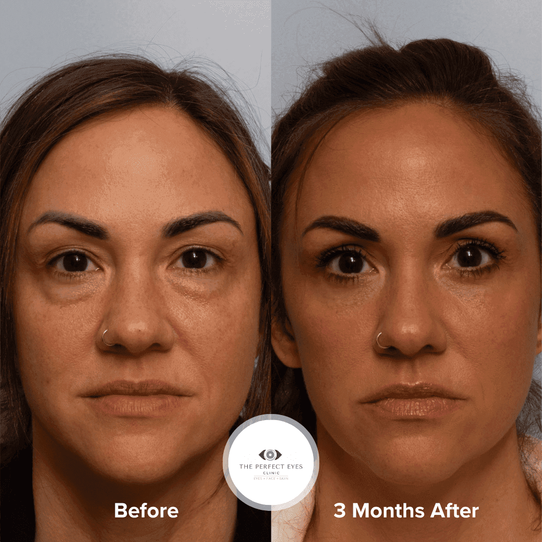 Upper and Lower Eyelid Blepharoplasty before and after, a patient of Dr Sabrina Shah-Desai