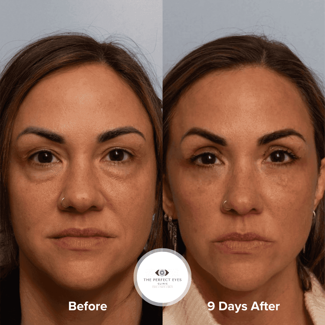 Upper and Lower Eyelid Blepharoplasty before and after, a patient of Dr Sabrina Shah-Desai