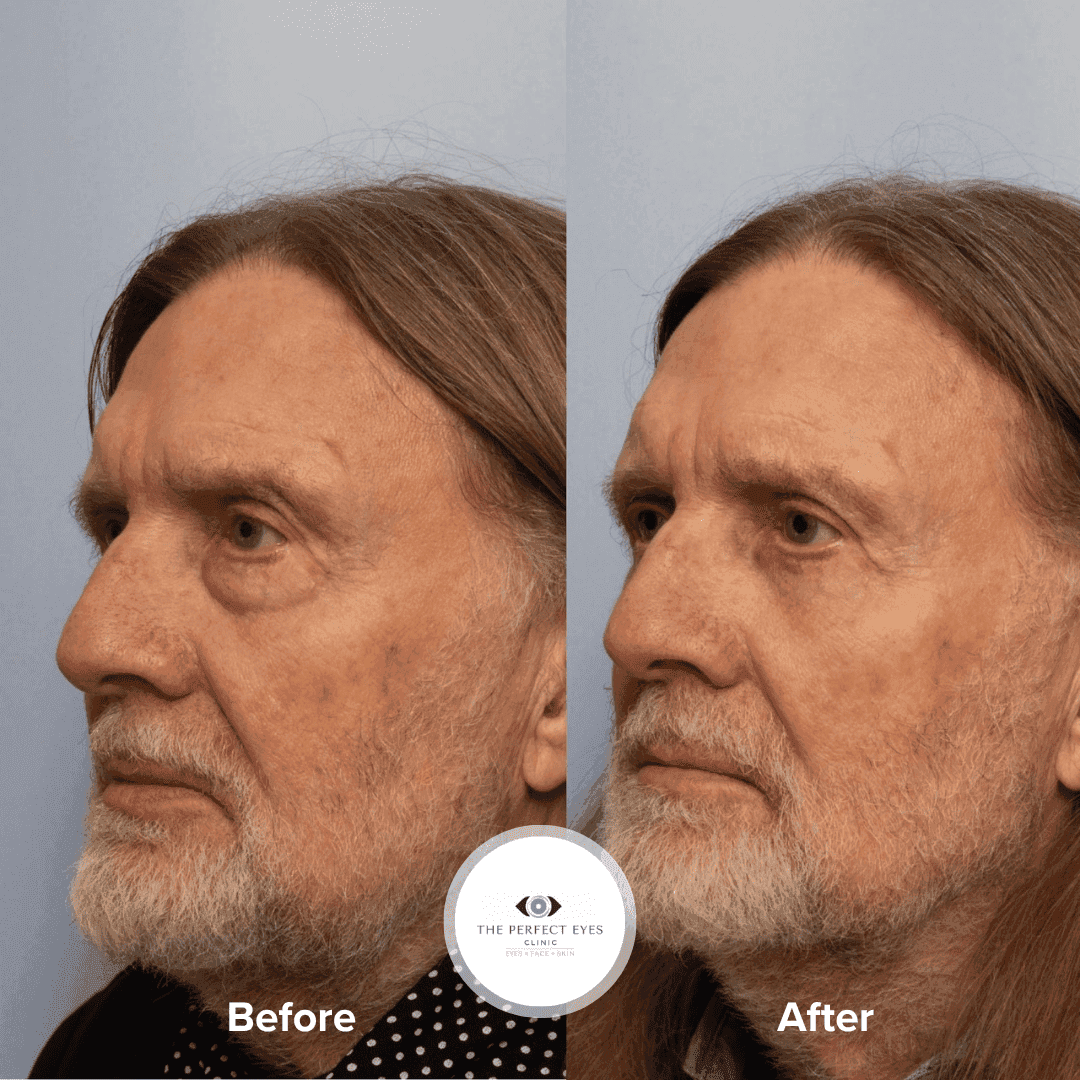 Lower Blepharoplasty before and after, a patient of Dr Sabrina Shah-Desai