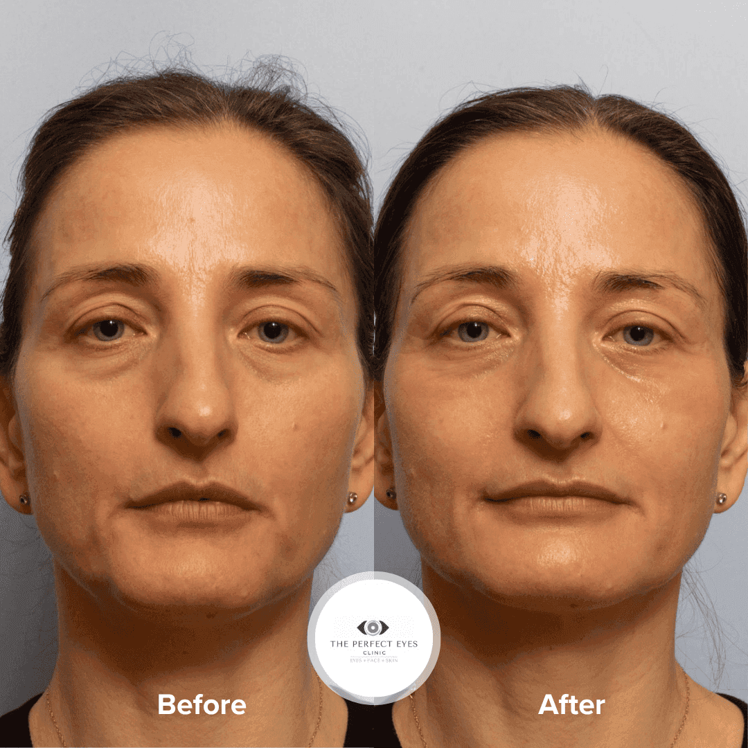 Ultraclear Laser before and after, a patient of Dr Sabrina Shah-Desai