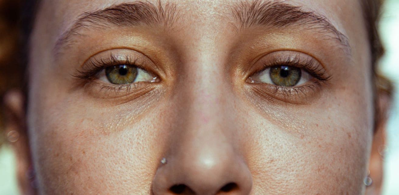 Hollow Eyes in Young People: Why It Happens and What Causes It in Your 20s and 30s