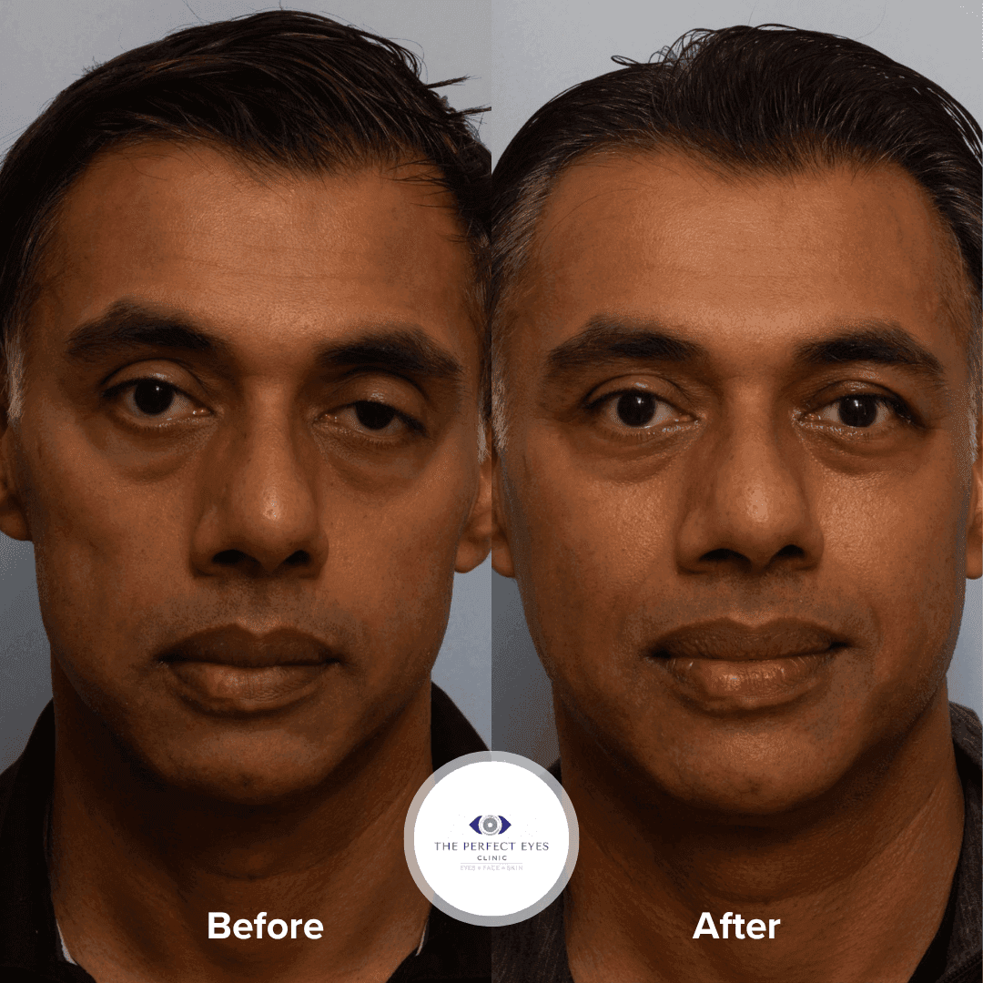 Ptosis Surgery before and after, a patient of Dr Sabrina Shah-Desai