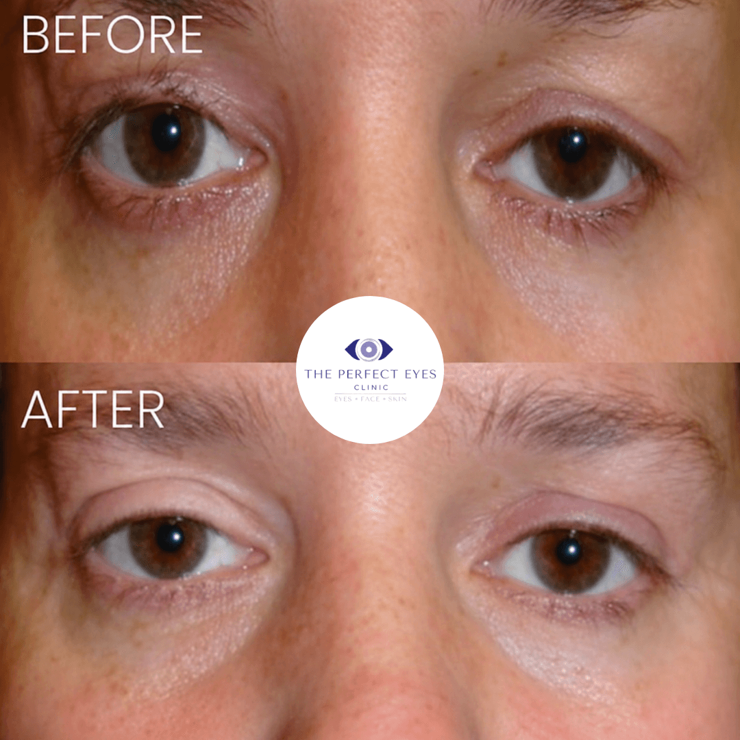 Revision blepharoplasty before and after, case 1, by Dr Sabrina Shah-Desai