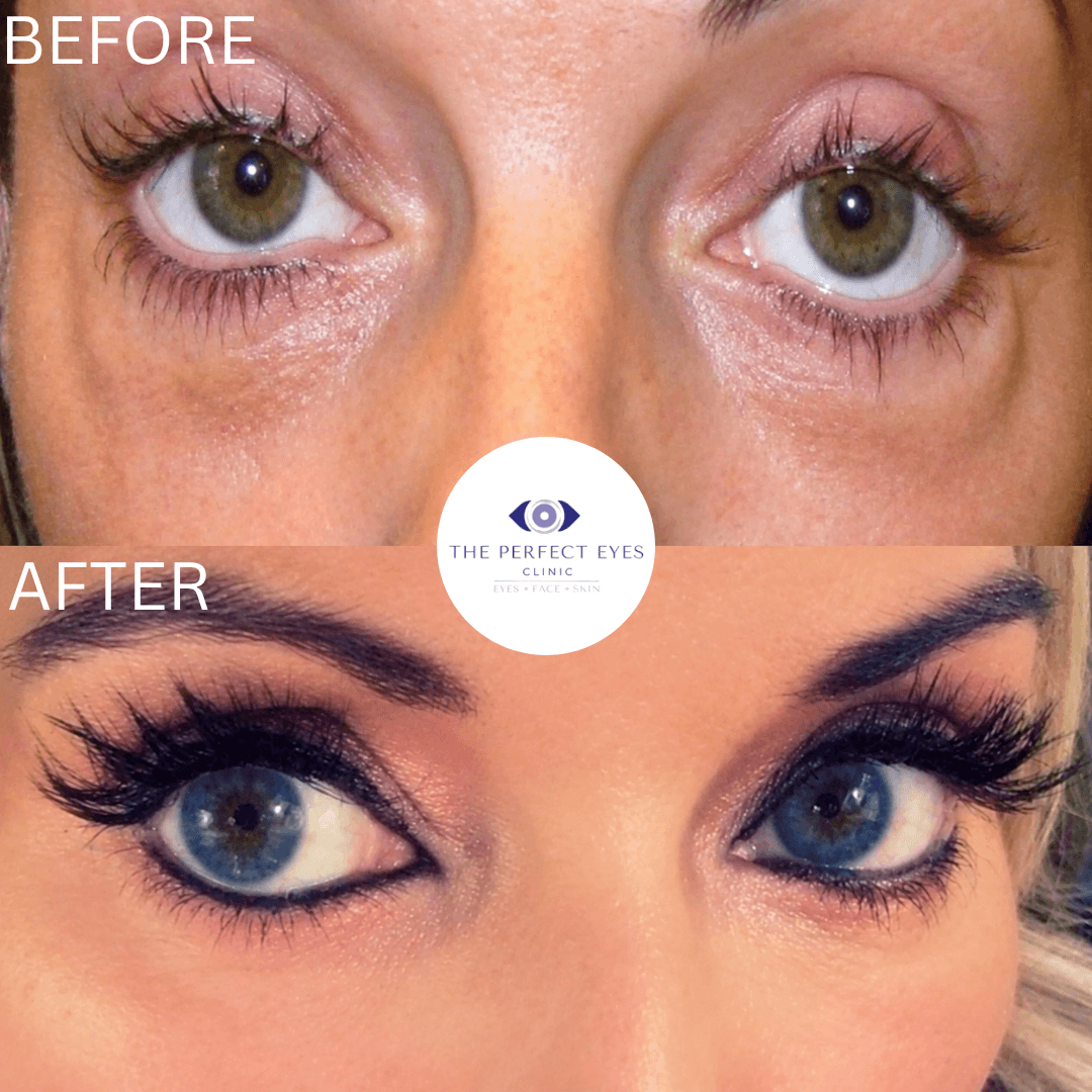 Revision blepharoplasty before and after, case 2, by Dr Sabrina Shah-Desai