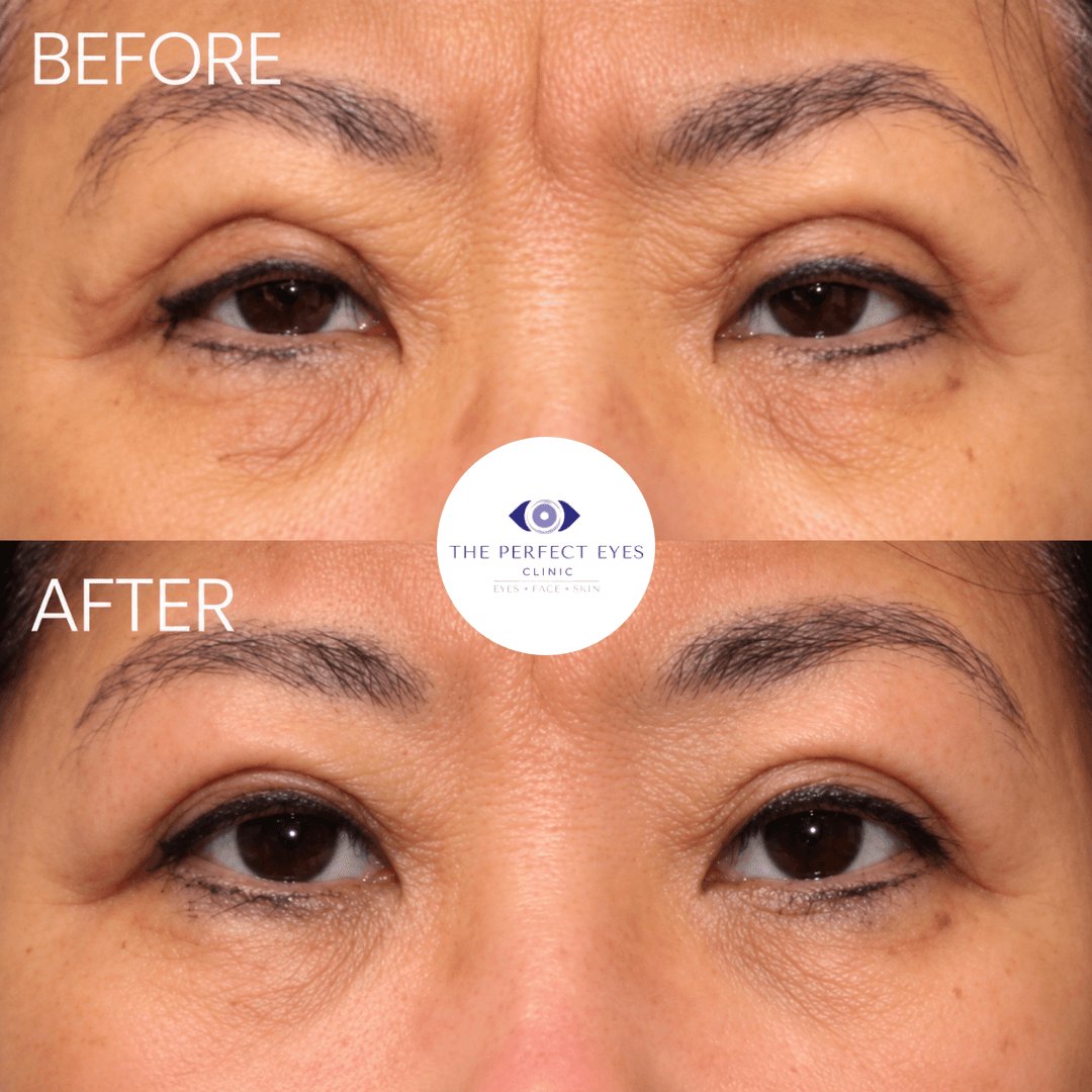 Revision blepharoplasty before and after, case 3, by Dr Sabrina Shah-Desai