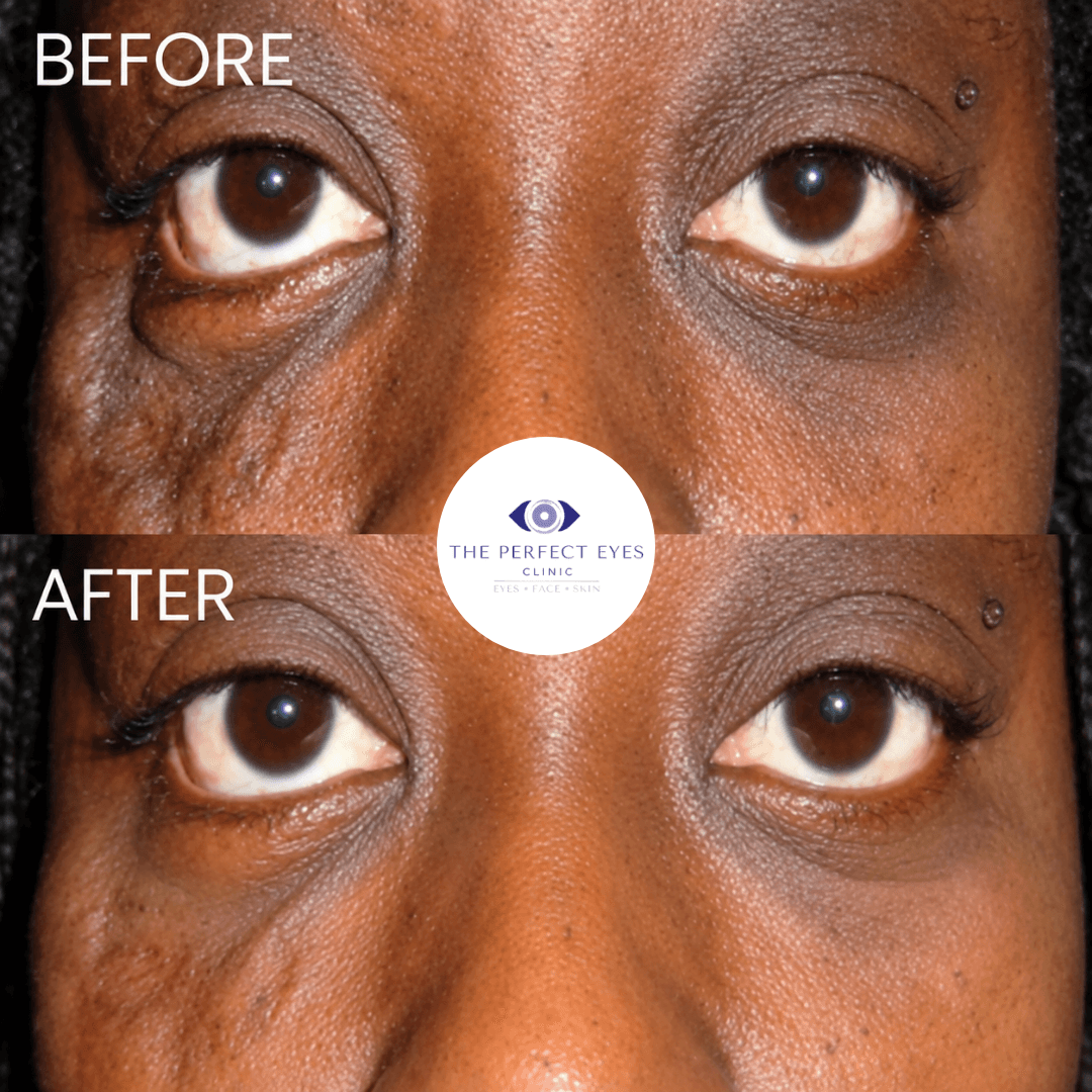 Revision blepharoplasty before and after, case 4, by Dr Sabrina Shah-Desai