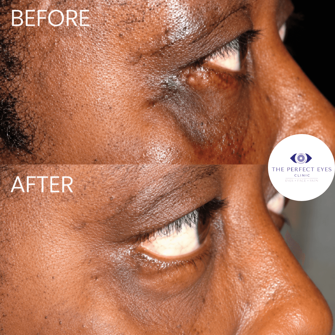 Revision blepharoplasty before and after, case 5, by Dr Sabrina Shah-Desai