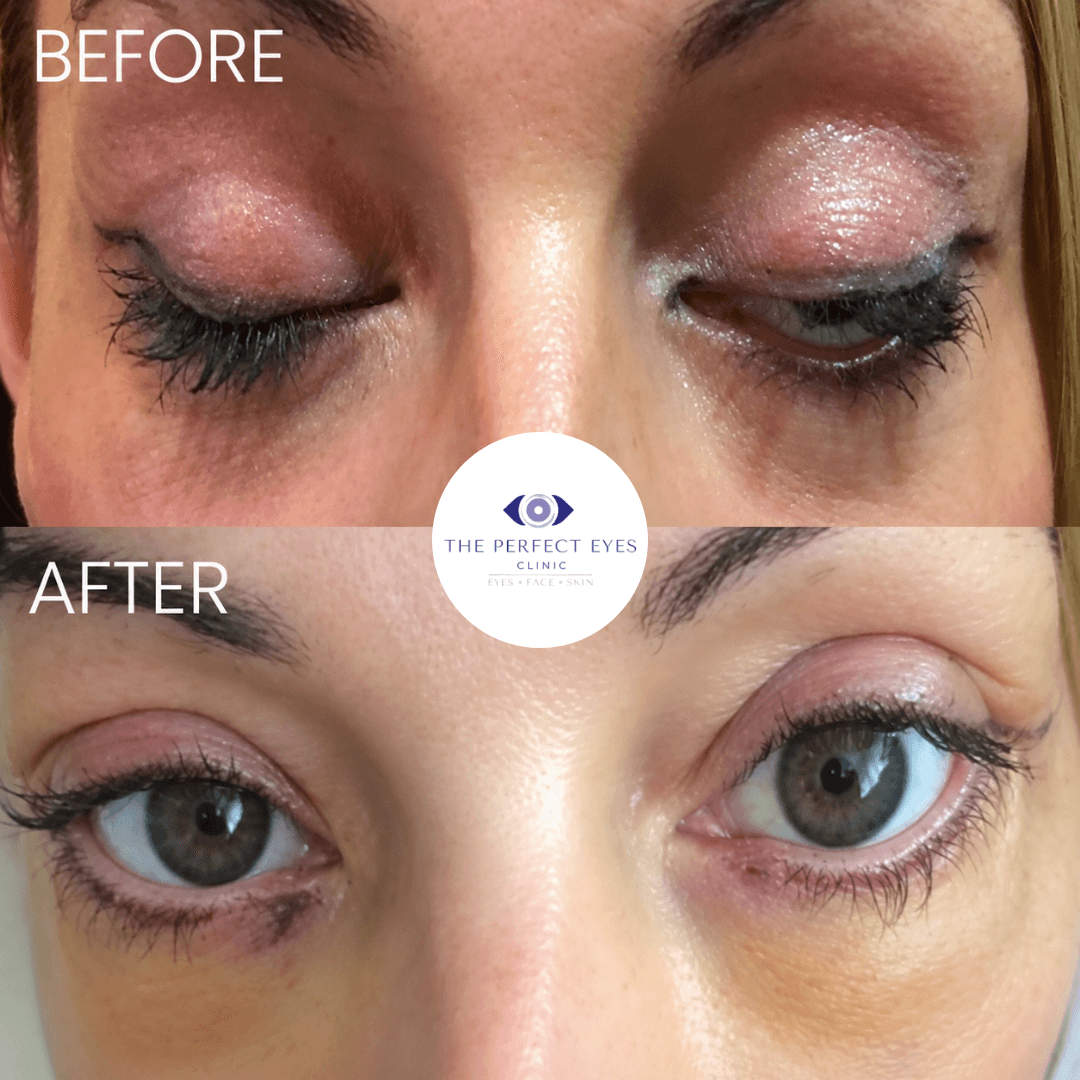 Revision blepharoplasty before and after, case 6, by Dr Sabrina Shah-Desai