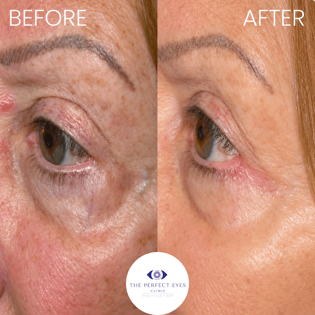 Revision blepharoplasty before and after, case 7, by Dr Sabrina Shah-Desai