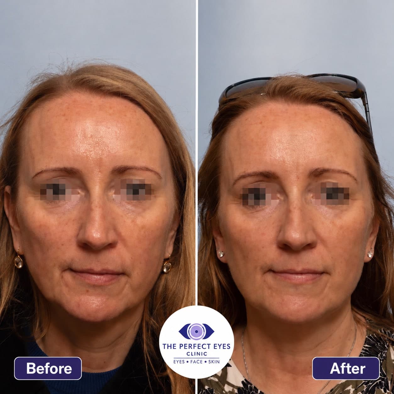 Sofwave™ before and after, a patient of Dr Sabrina Shah-Desai