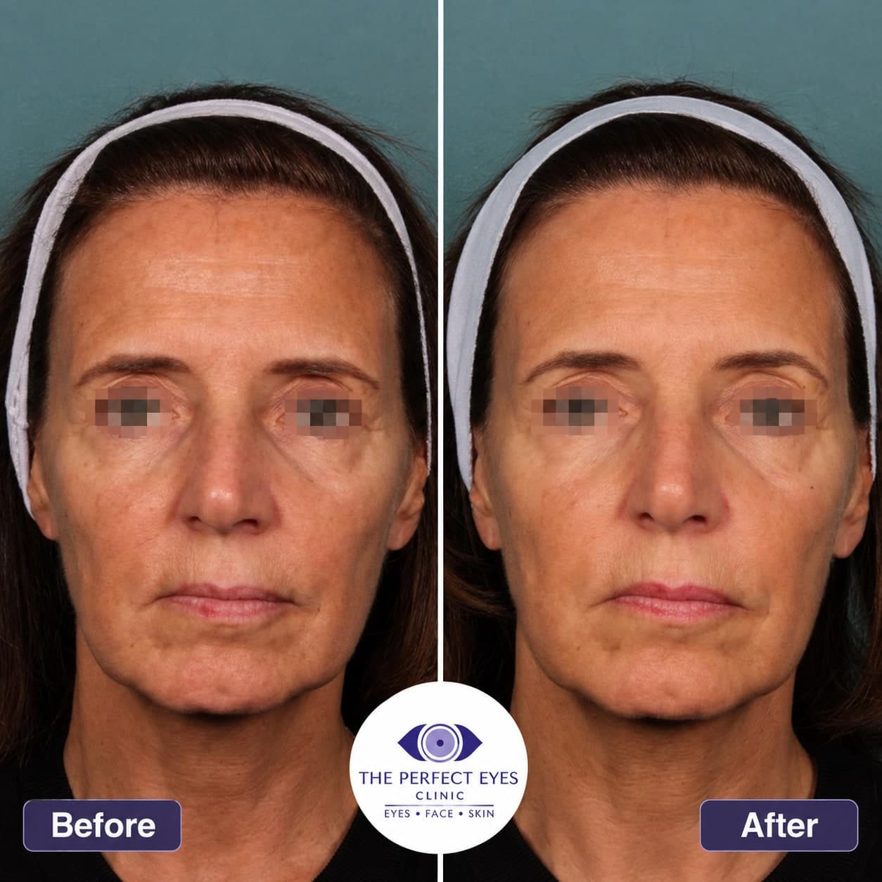 Sofwave before and after, case 2, by Dr Sabrina Shah-Desai