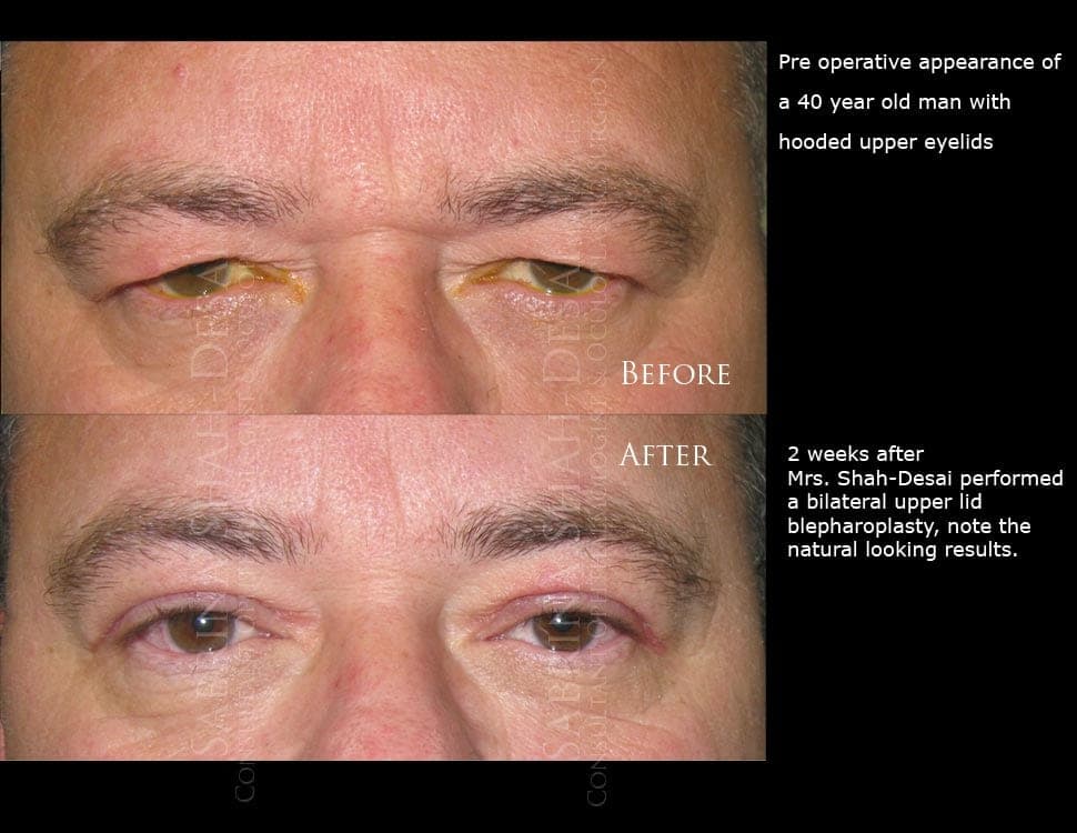 Case Study : Male Eyelid Lift (Blepharoplasty)
