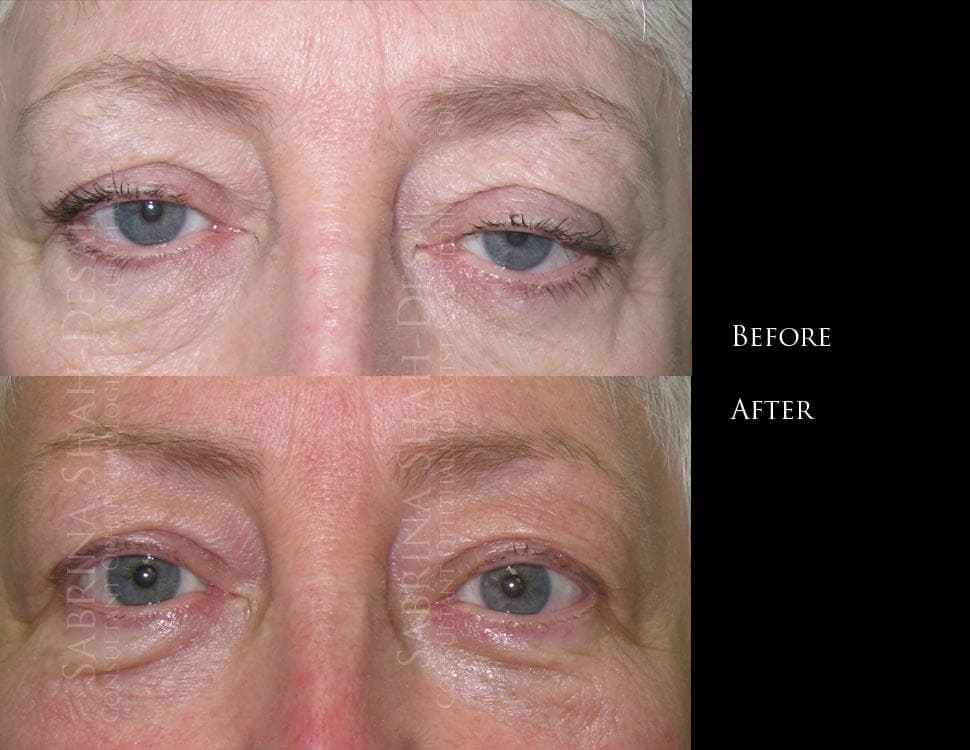 Case study : scarless droopy eyelid (ptosis) repair