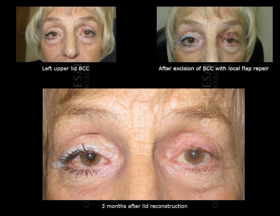 Case Study : Skin Cancer