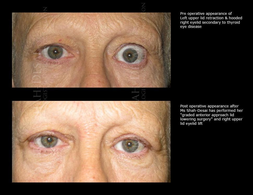 Case Study : Thyoid Eye Disease