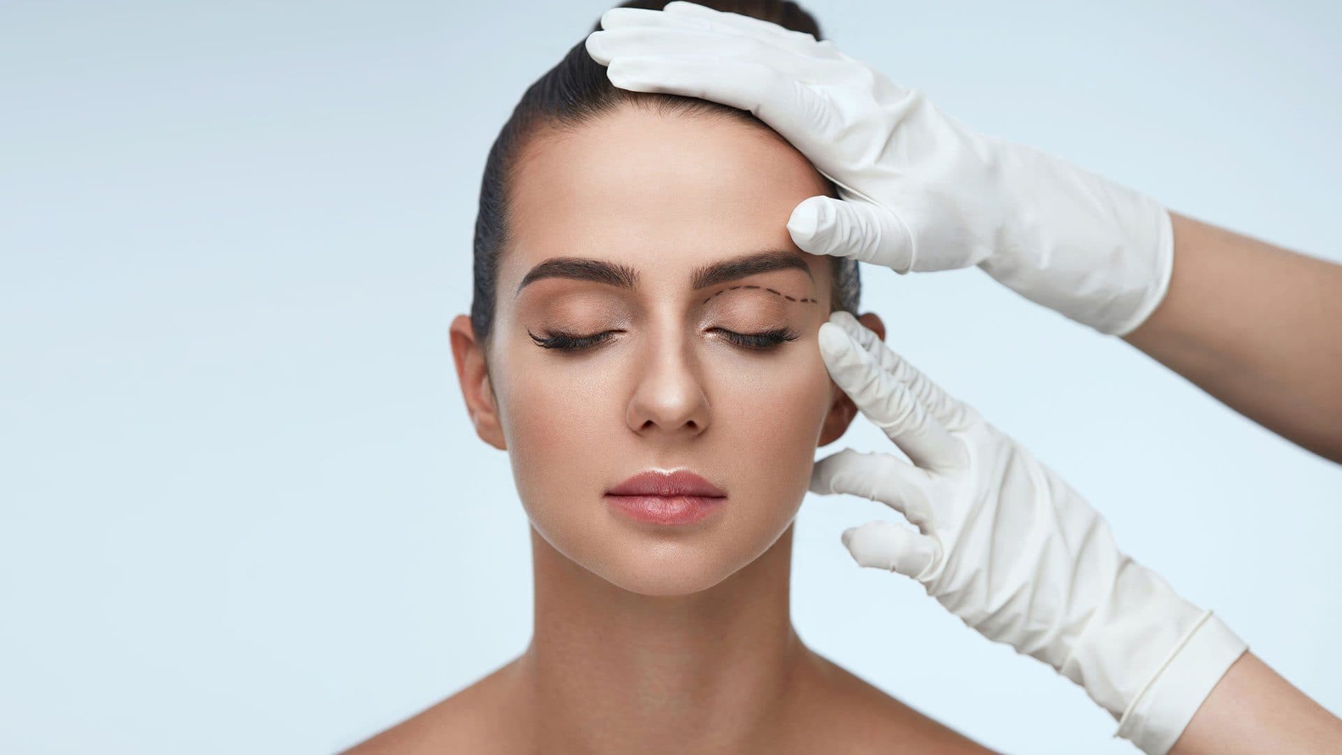 Upper lid blepharoplasty