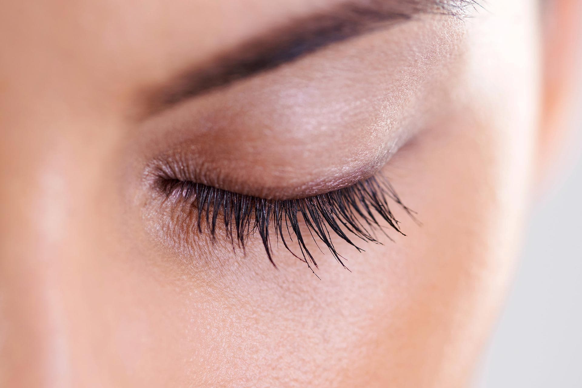 An upper eyelid resting low over the eye, the hallmark of ptosis