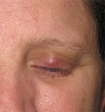 Chalazion Treatment (Eyelid Cyst Removal) illustration