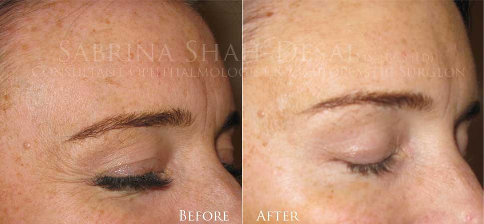 Periorbital Wrinkle Management (Neuromodulators) before and after, a patient of Dr Sabrina Shah-Desai