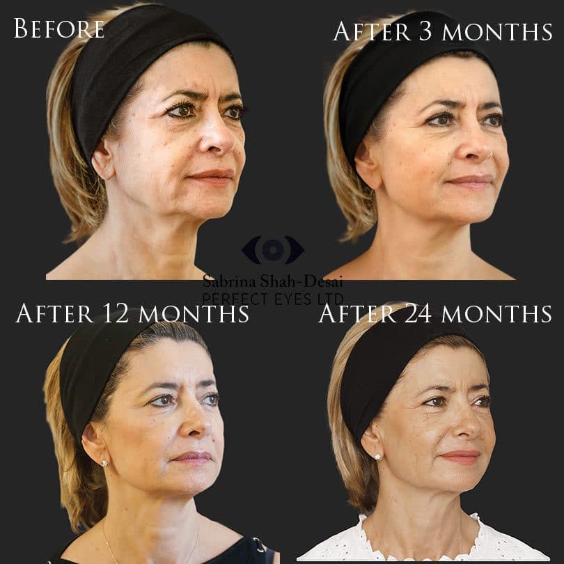 Biostimulation