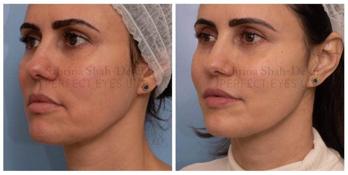 Silhoutte Soft before and after, a patient of Dr Sabrina Shah-Desai