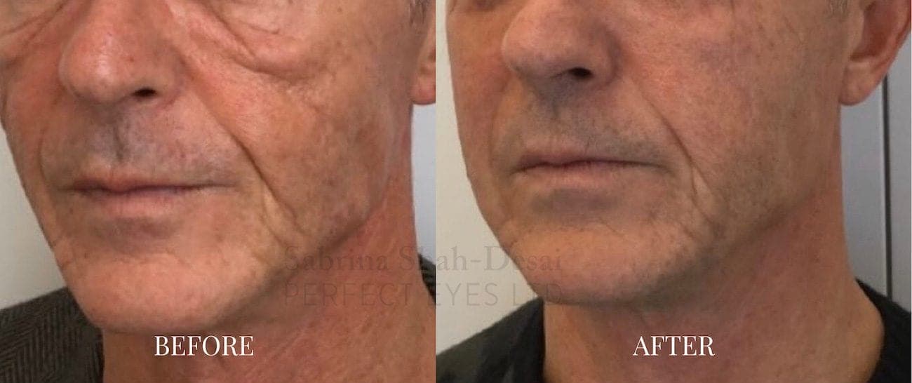 Morpheus8: Radio Frequency Skin Tightening Treatment before and after, a patient of Dr Sabrina Shah-Desai