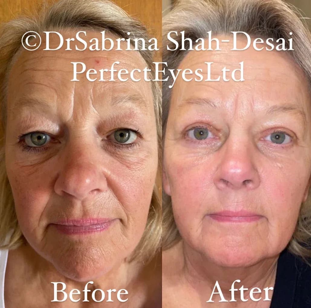 UltraClear Laser before and after - case 14