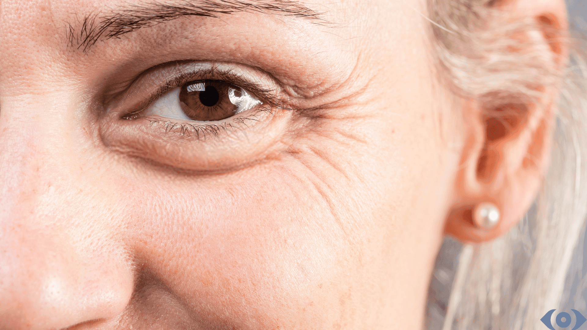 How to Eliminate Fine Lines Under Eyes? Causes & Treatments