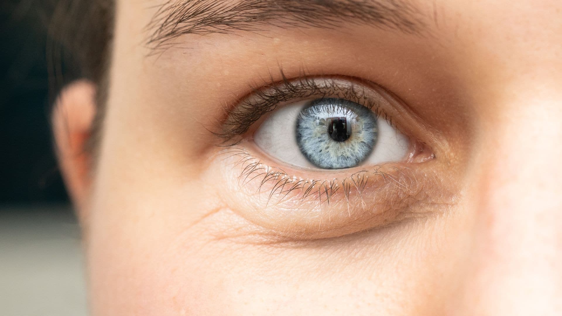 Bags Under Your Eyes - Your Ultimate Guide