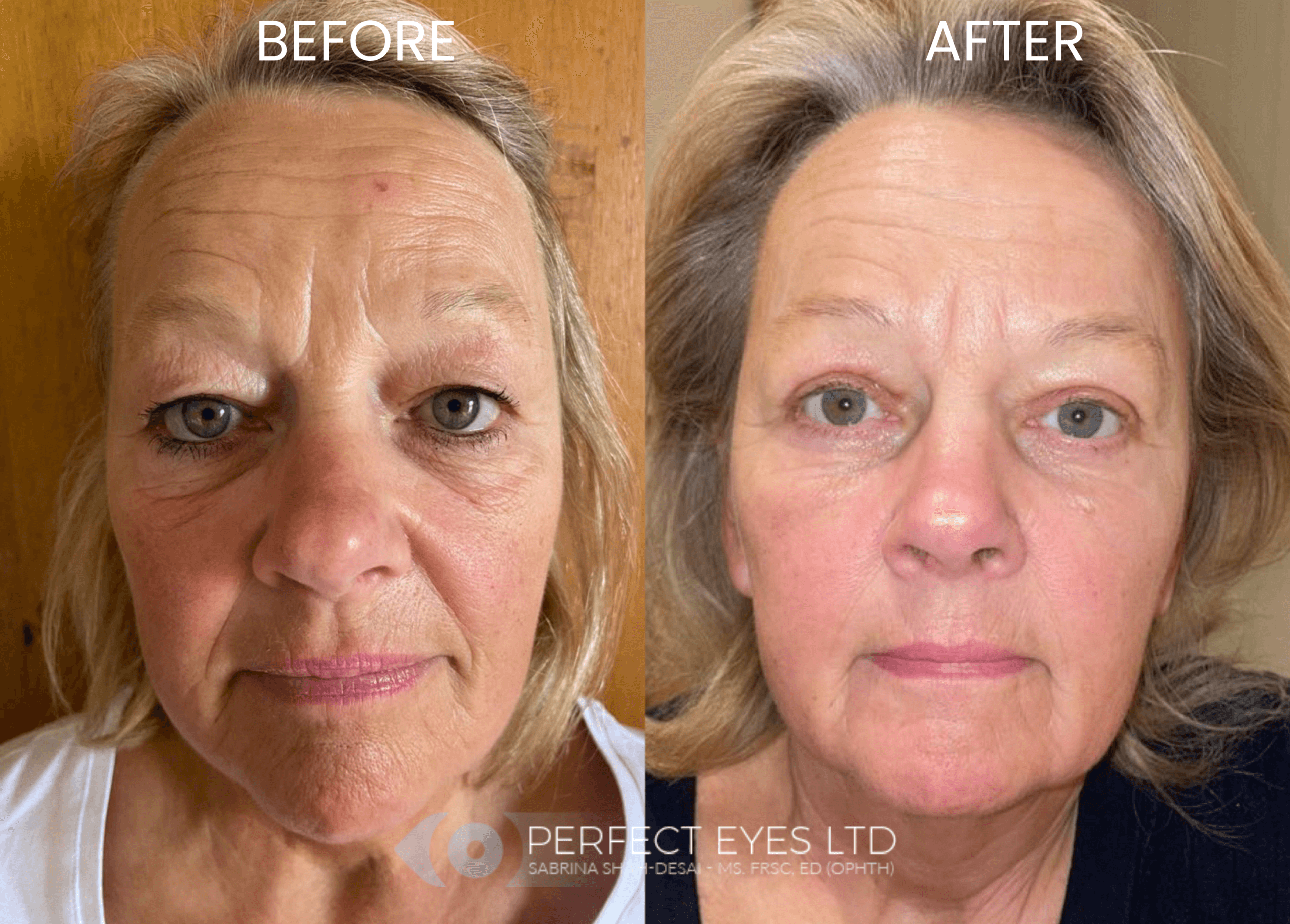 UltraClear Laser before and after - case 5