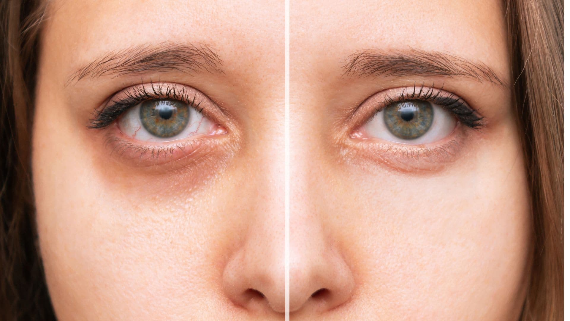 How to Remove Dark Circles Under Eyes Permanently?