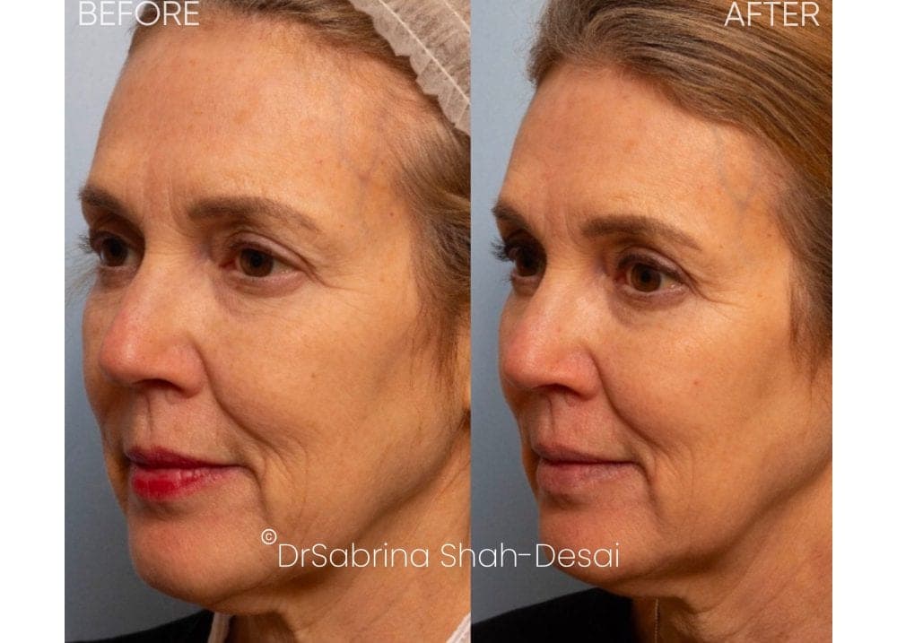 UltraClear Laser before and after - case 8