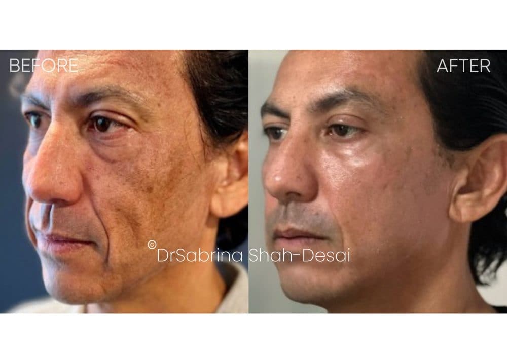 UltraClear Laser before and after - case 9