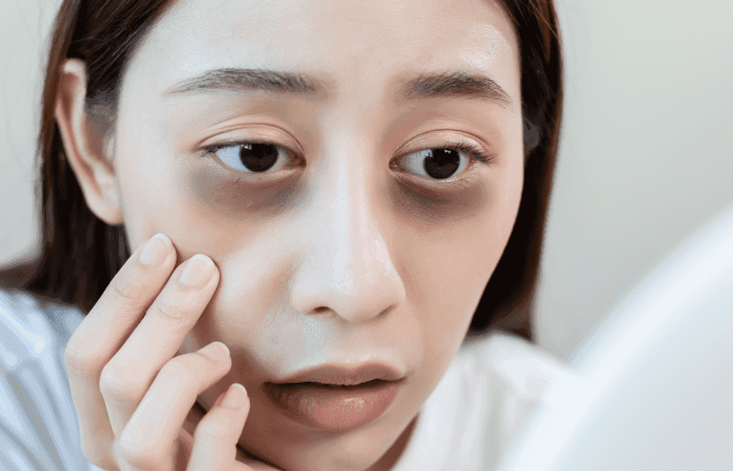 How to Get Rid of Sunken Eyes