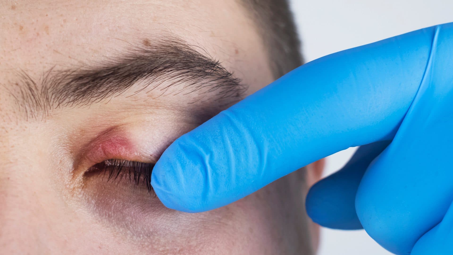 Blepharitis: Your Ultimate Guide 2025