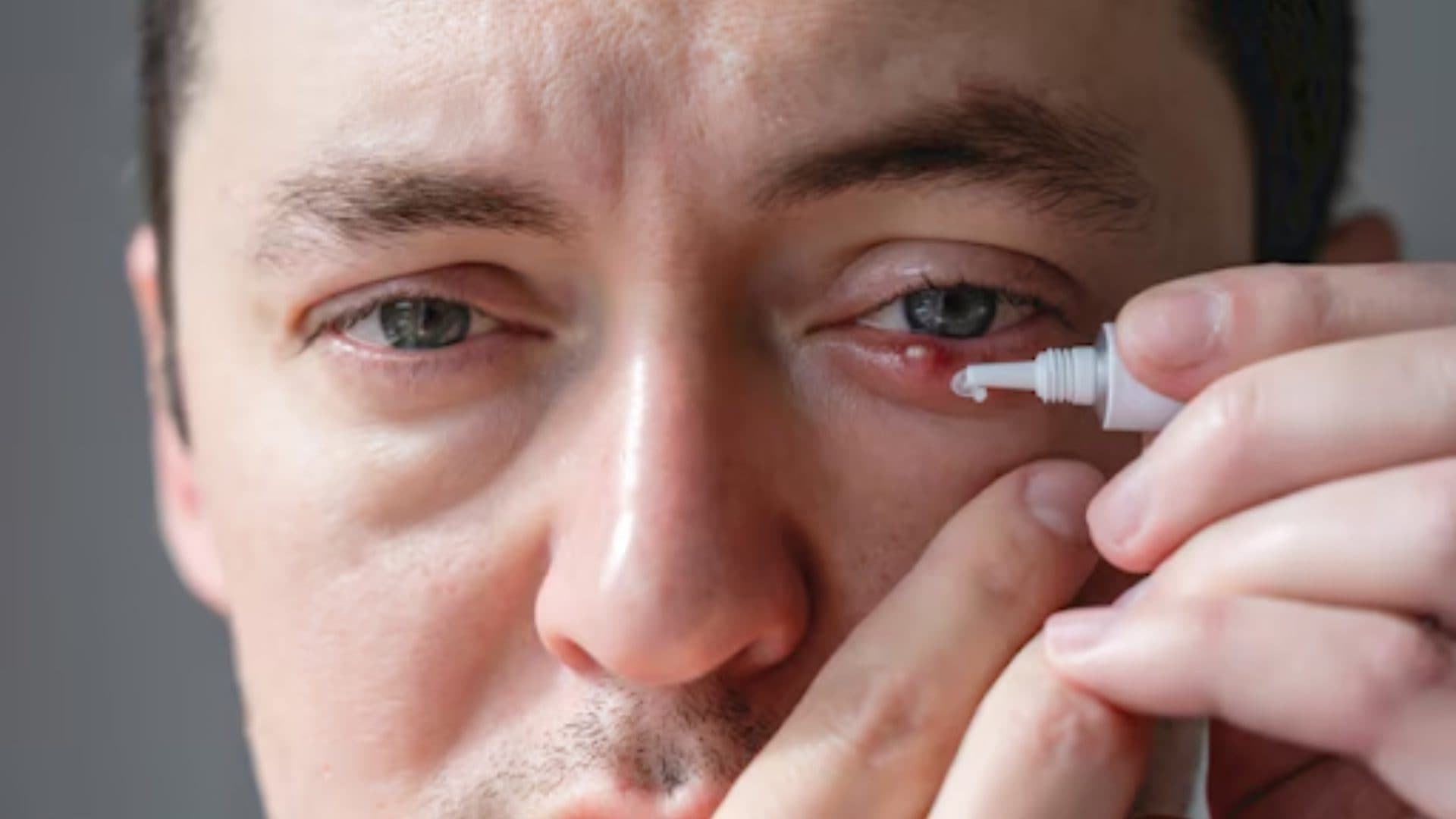 Chalazion Healing Stages: Care Tips & Pictures