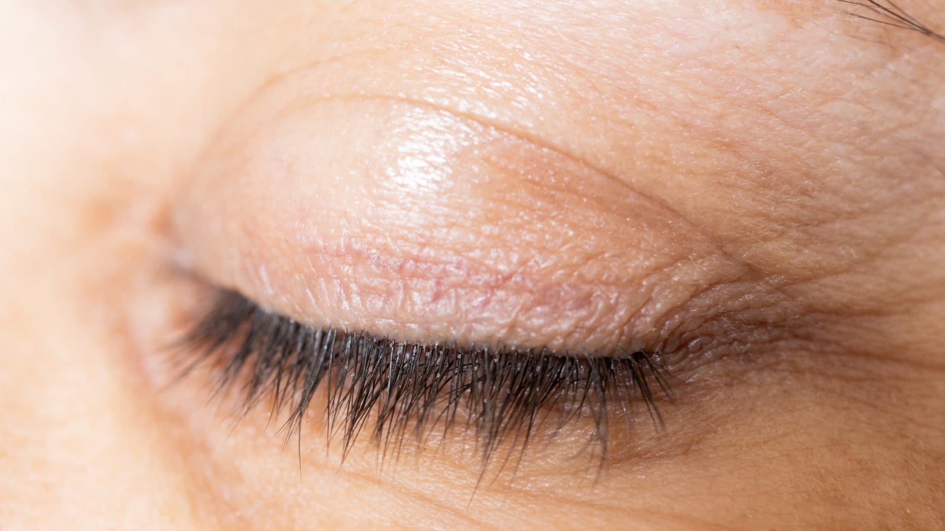 How to Cure Blepharitis Fast?
