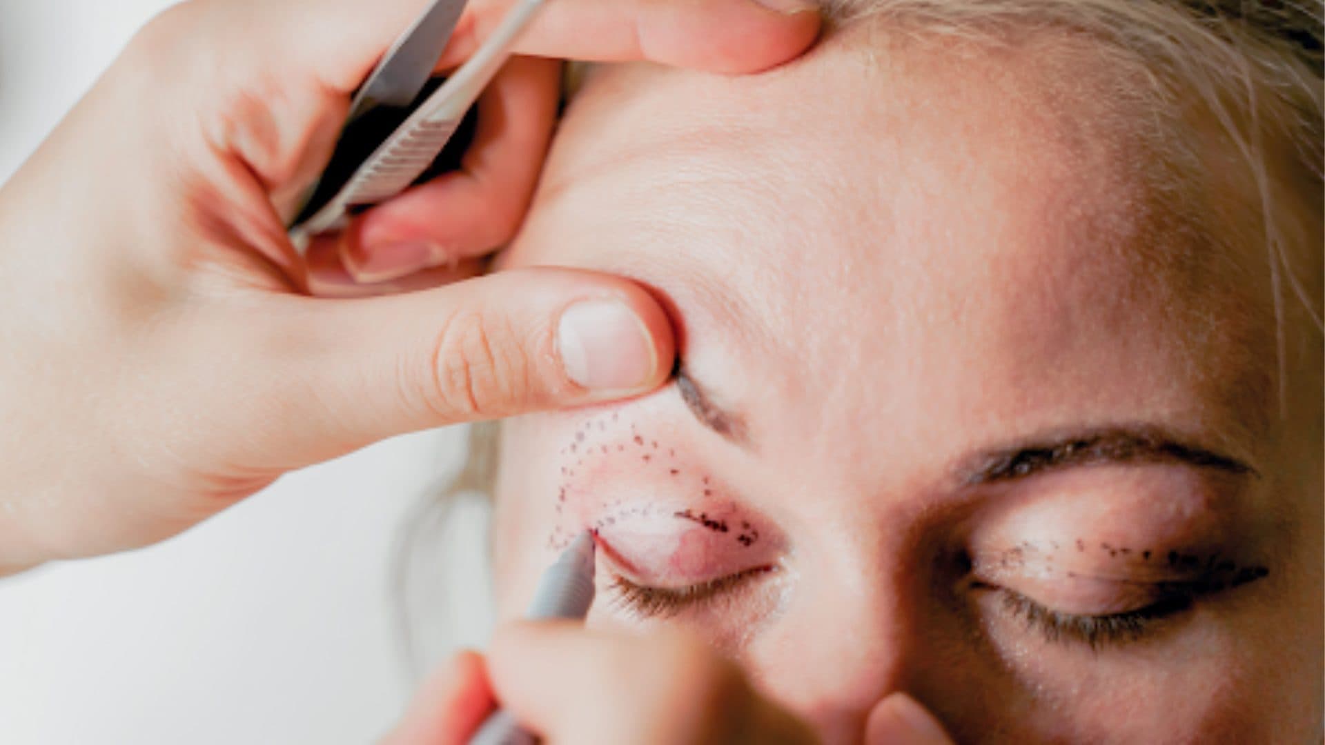 Ptosis Surgery Recovery
