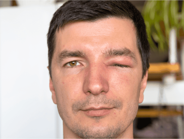 What are Swollen Eyelids?