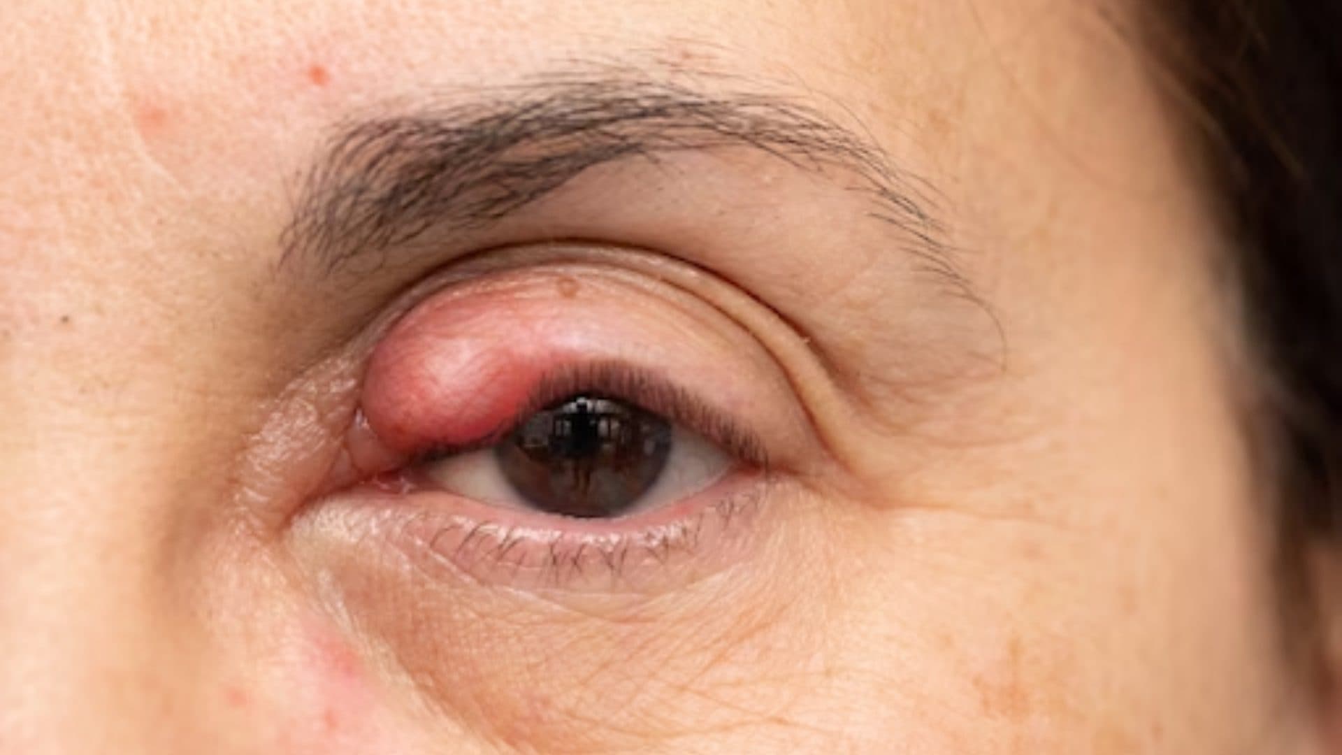 How is a Chalazion Removed?