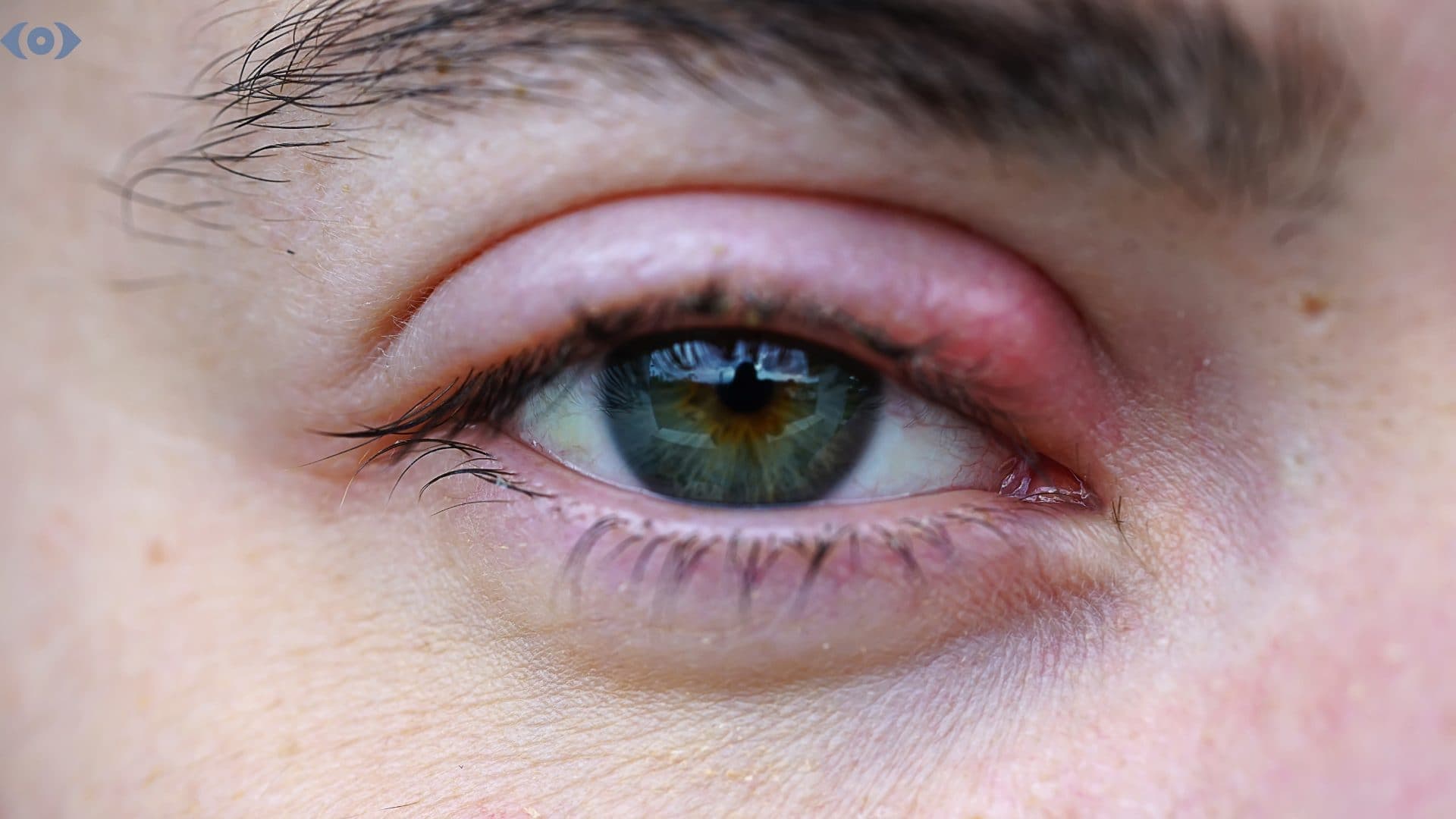 How Long Does a Stye Last