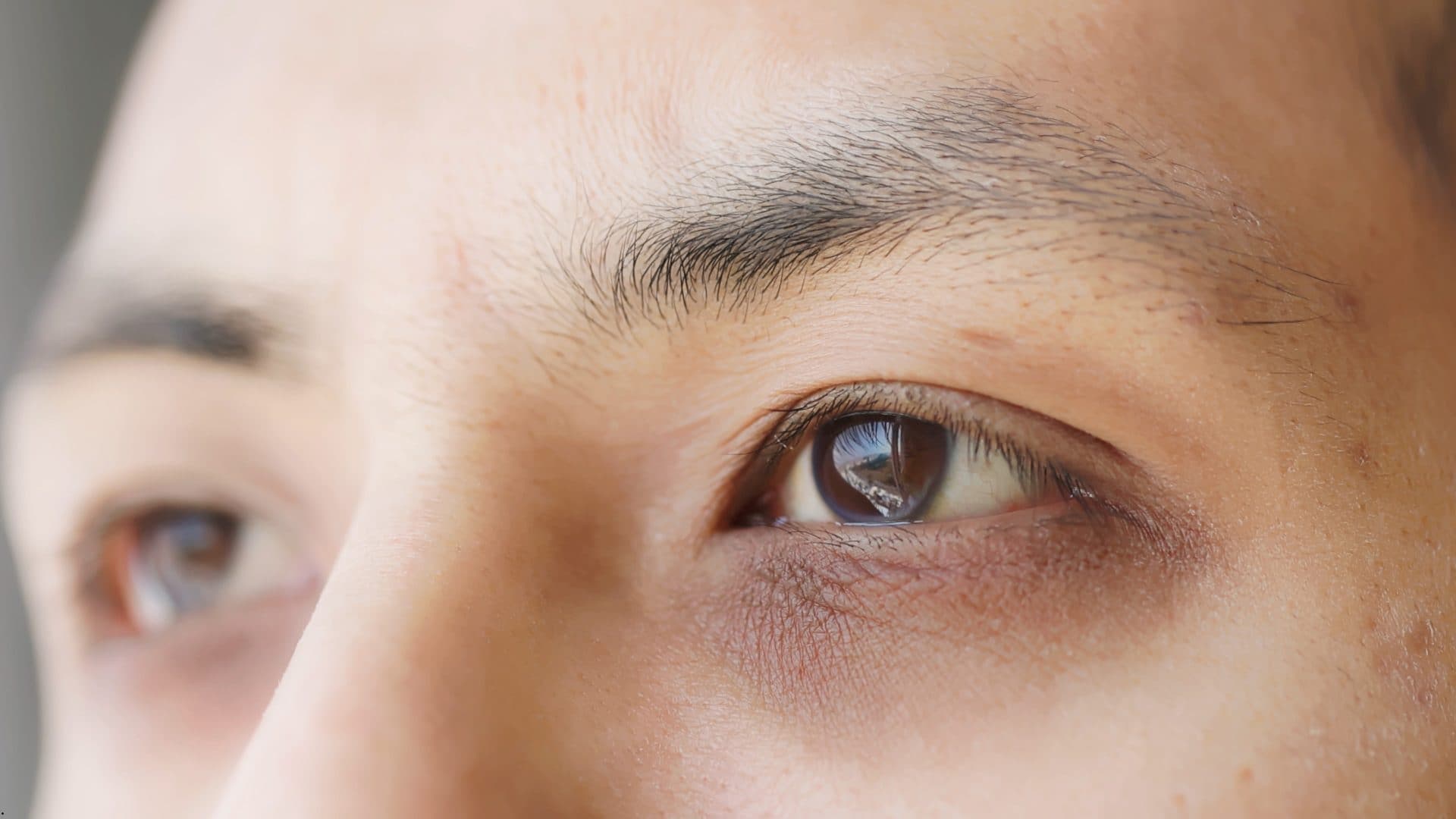 Types of Dark Circles: Causes and How to Identify them