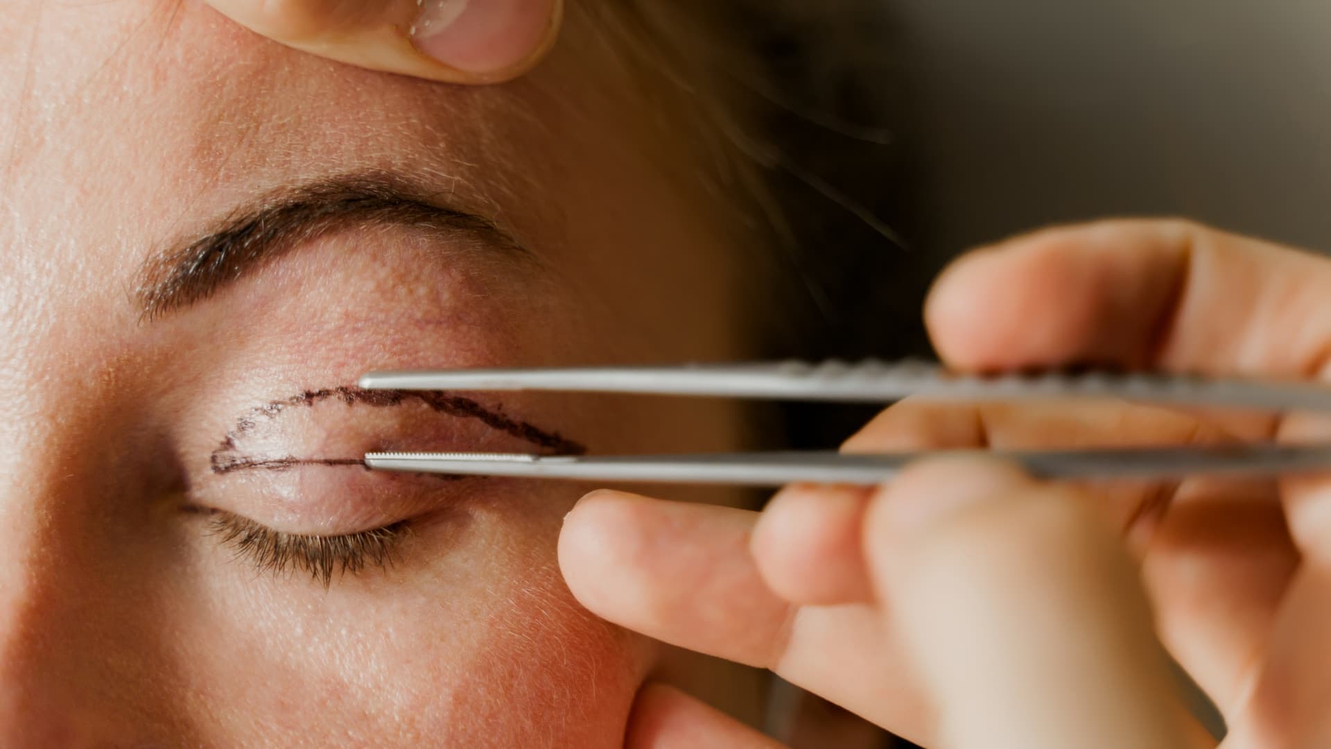 Botched Eyelid Surgery: Causes and Complications