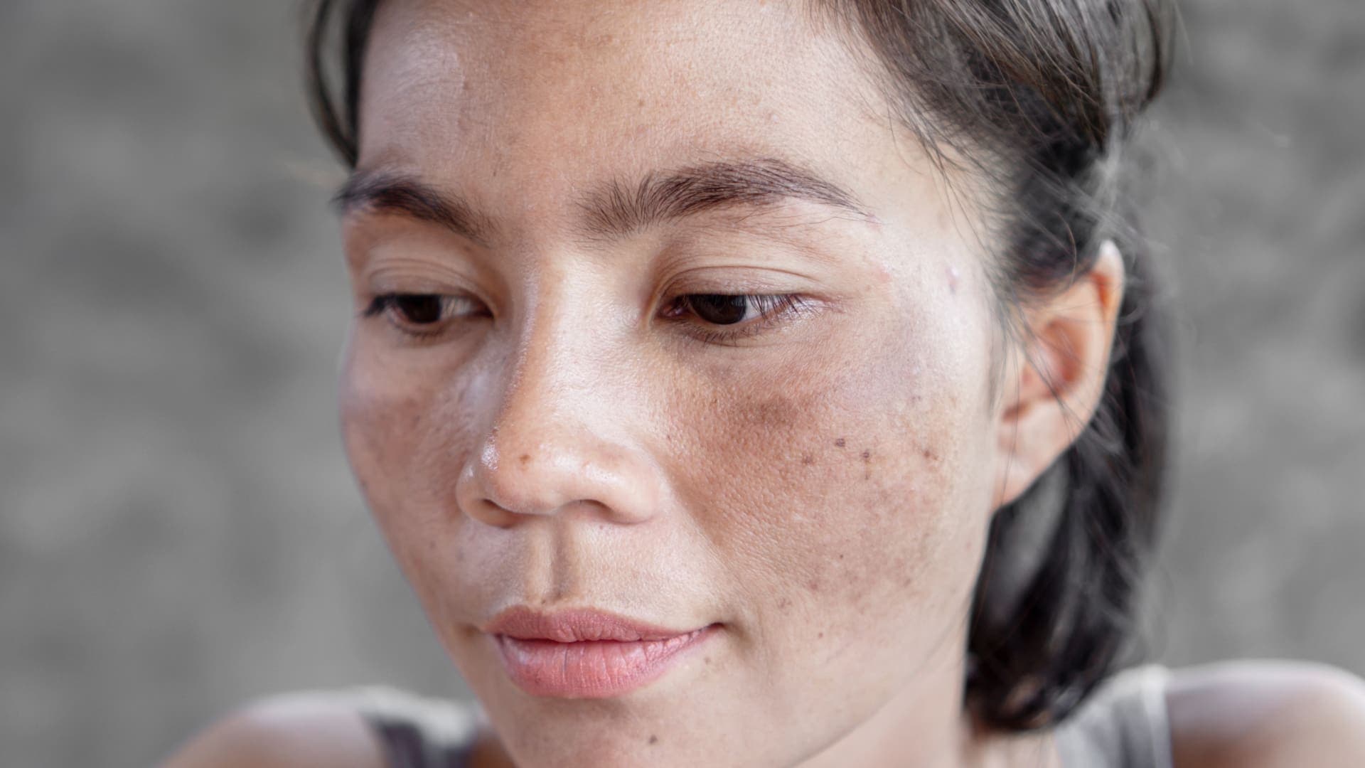 How to Remove Sun Damage on Face?
